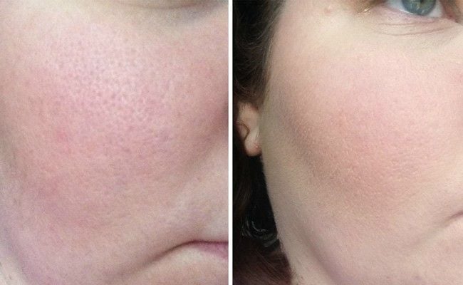 Proteção Solar Diária: Prevenindo o Alargamento - inspiração 1