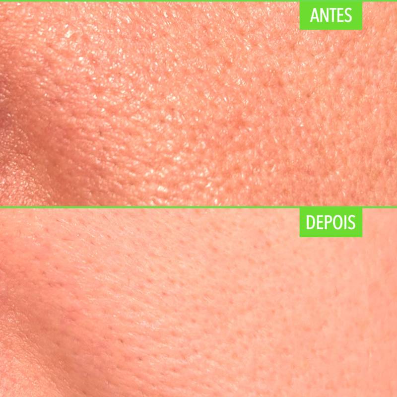 Proteção Solar Diária: Prevenindo o Alargamento - inspiração 2