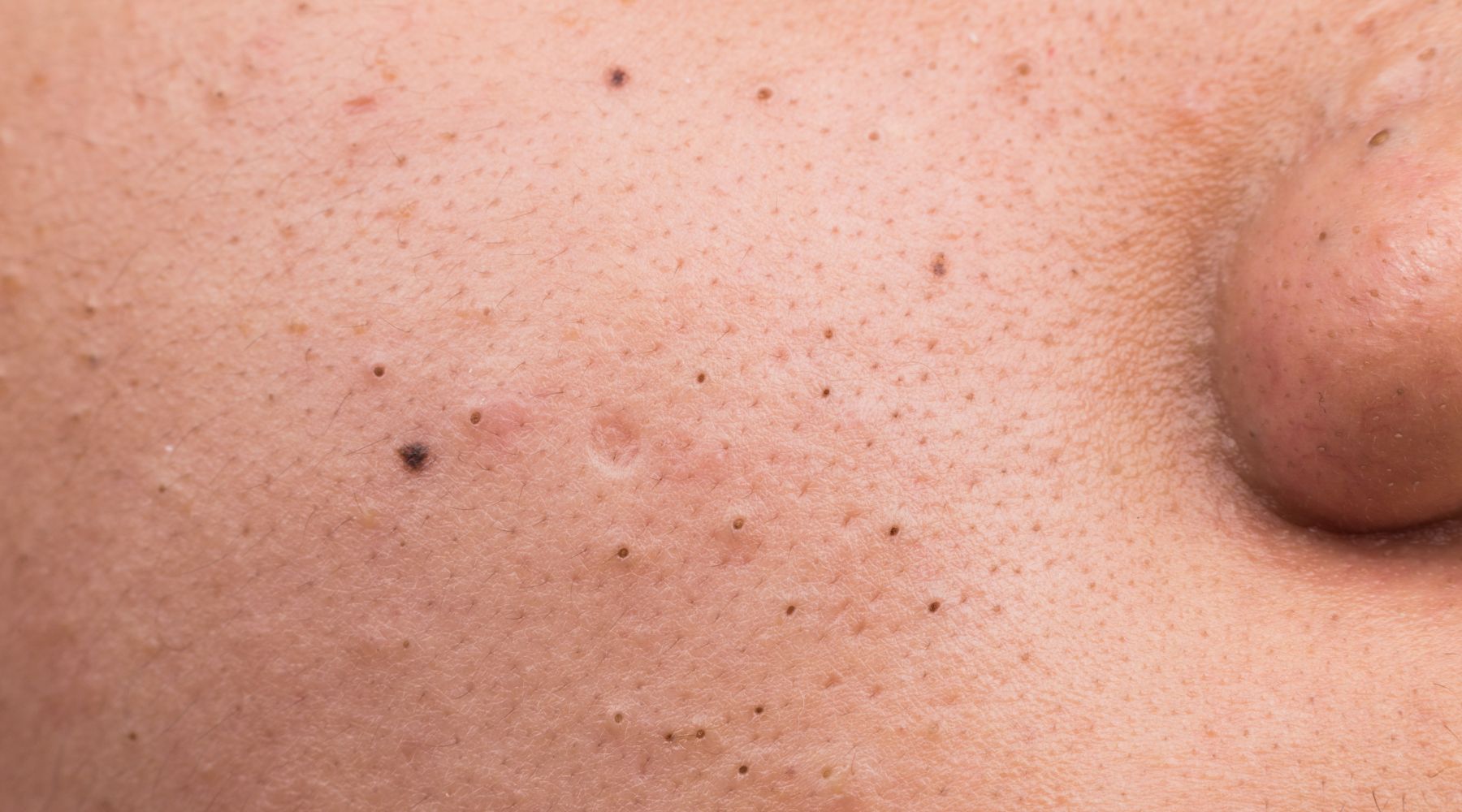 A Real Causa dos Cravos: Poros Entupidos e Oleosidade Excessiva - inspiração 1