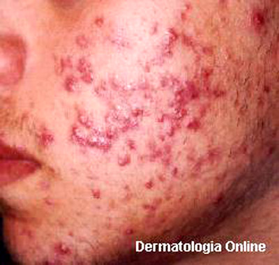 O Poder da Microbiota da Pele: Um Exército Invisível Que Luta Contra Bactérias - inspiração 1