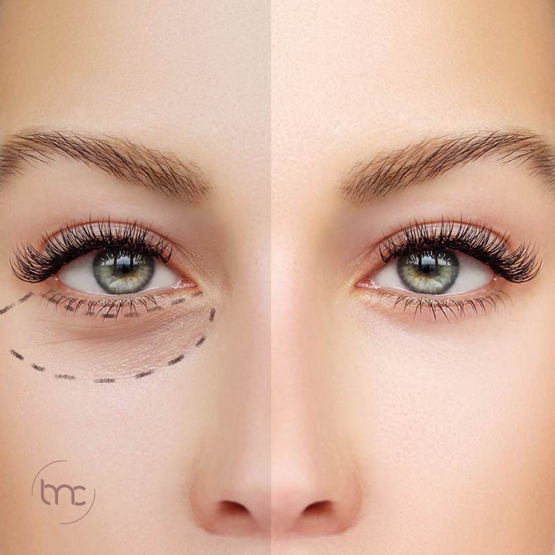 Proteção Solar: Um Escudo Indispensável Contra o Agravamento das Olheiras - inspiração 1