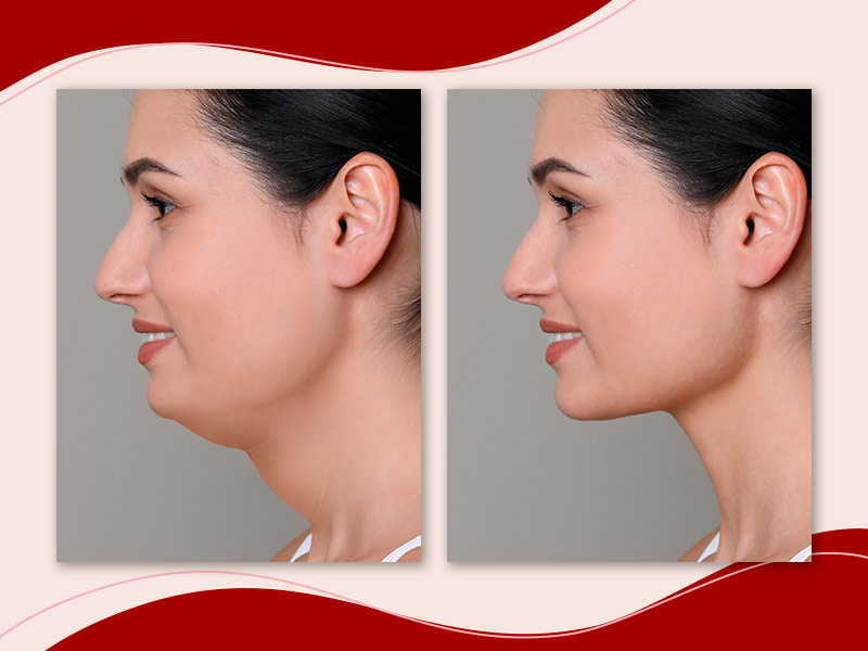 Efeitos Colaterais da Lipo de Papada Enzimática: O Que Esperar?