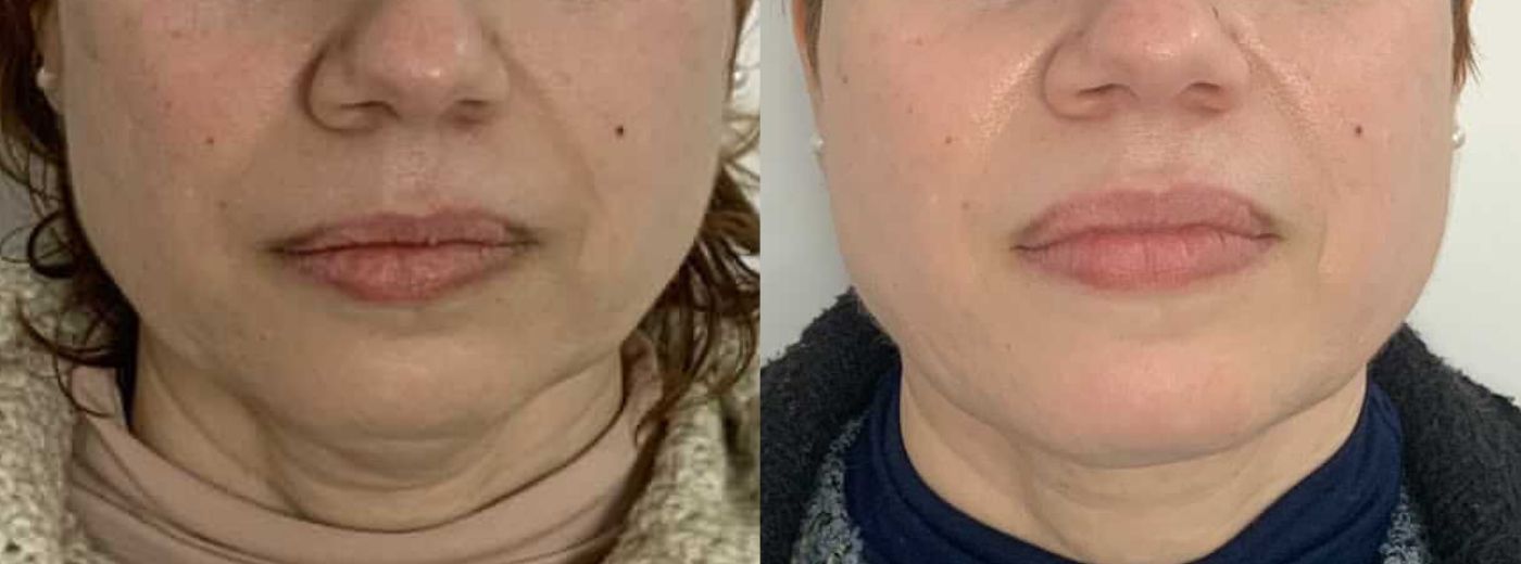 Lipo de Papada: Comparativo entre Ácido Deoxicólico e Outros Tratamentos