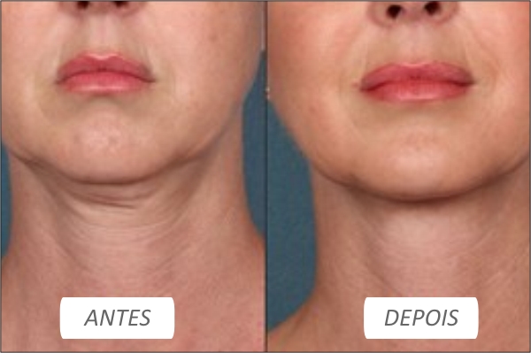 Efeitos Colaterais da Lipo de Papada Enzimática: O Que Esperar?