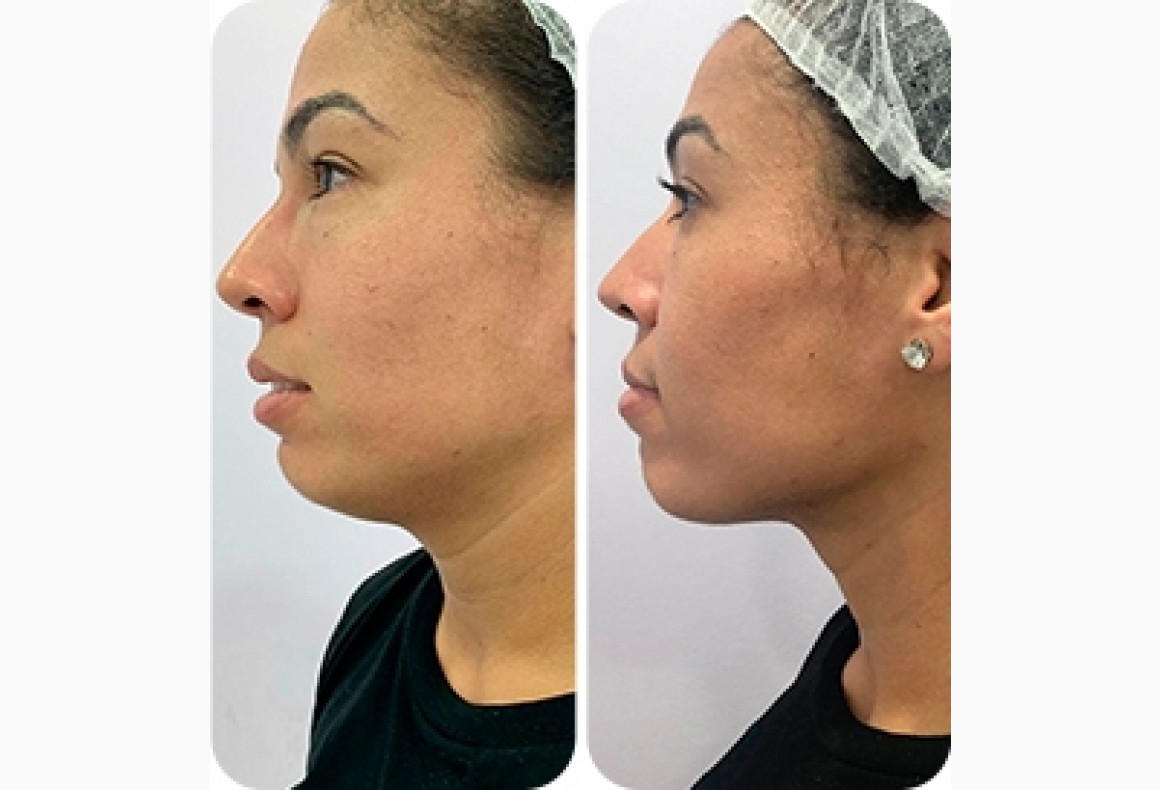 Como Escolher a Melhor Clínica para Lipo de Papada com Ácido Deoxicólico