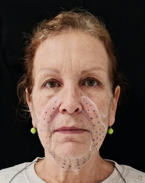 Ácido Deoxicólico Valor