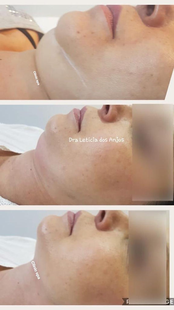 Ácido Deoxicólico: Guia Completo sobre Lipo de Papada Enzimática