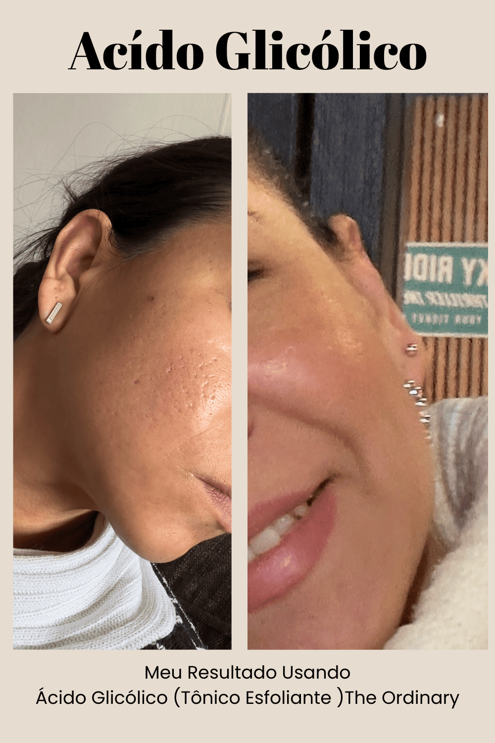 ácido glicolico para que serve