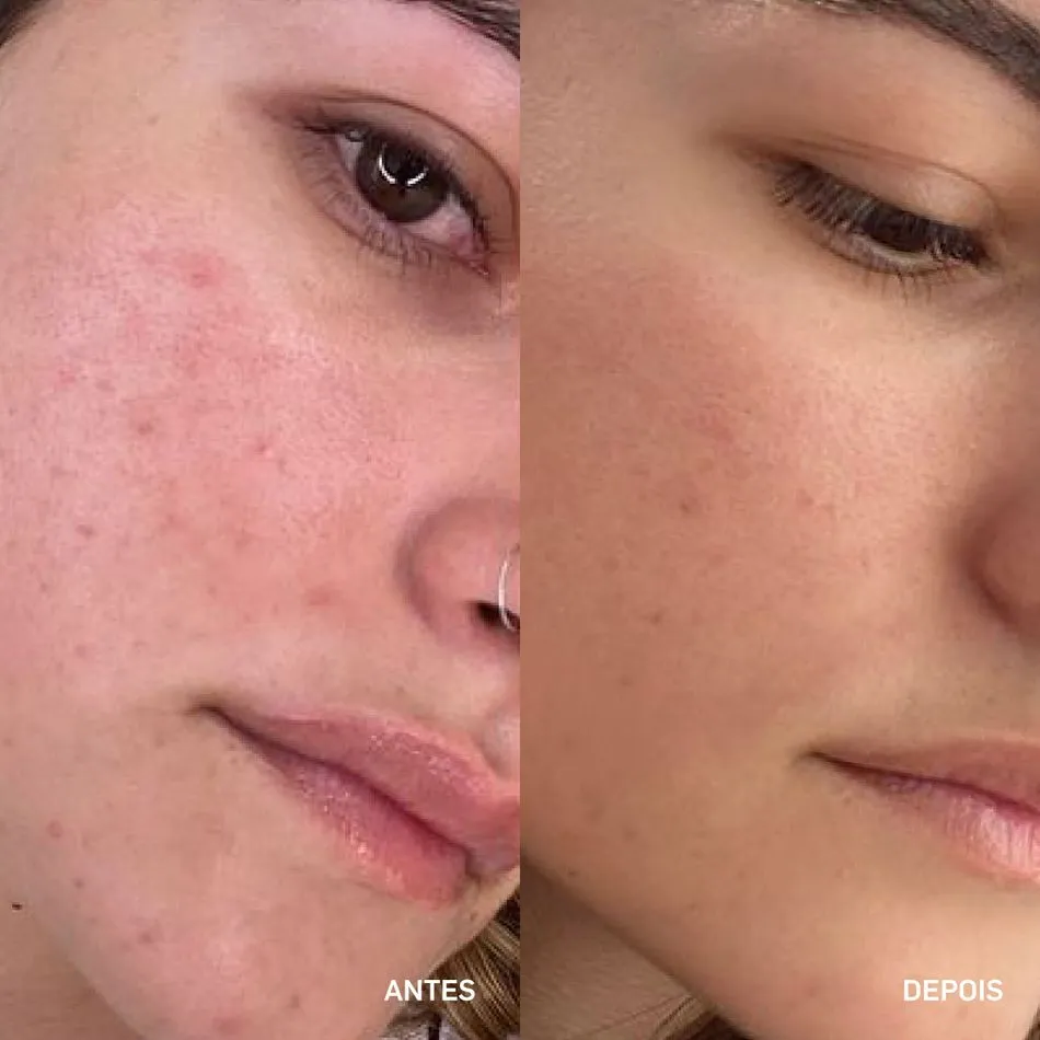 Guia Completo: Como Incluir o Ácido Glicólico na Sua Rotina de Skincare