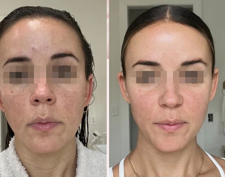 Ácido Glicólico e Manchas: O Segredo para uma Pele Uniforme e Luminosa