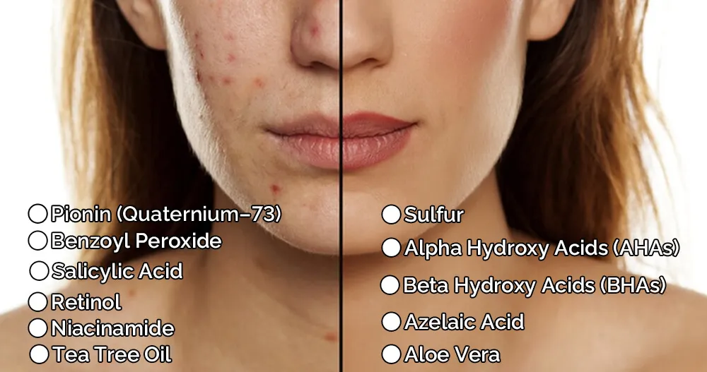 Ácido Salicílico vs. Ácido Azelaico: Entenda as Diferenças e Benefícios