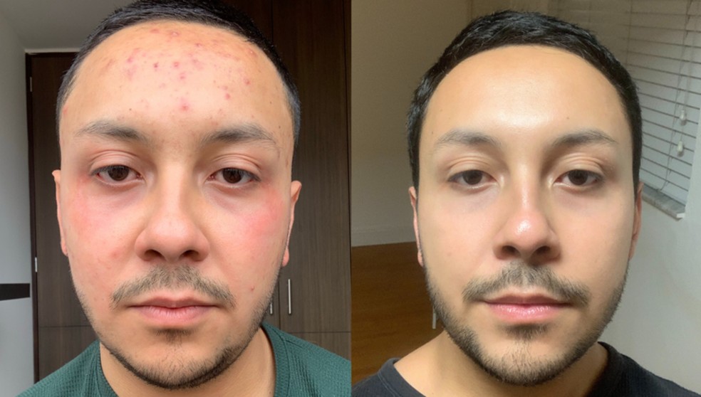 acne tratamento