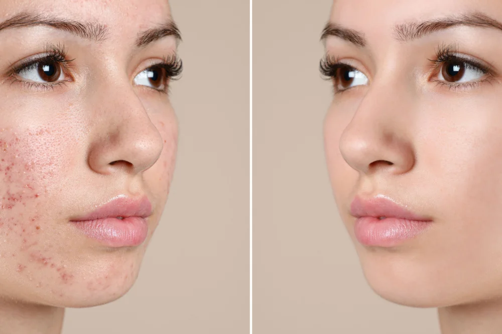 1. Rotina de Skincare para Pele Acneica: Passo a Passo
2. Isotretinoína: Tudo o que Você Precisa Saber Antes de Usar
3. Antibióticos para Acne: Quando São Indicados?
4. Tratamentos Naturais vs. Medicamentosos para Acne
5. Como Lidar com Cicatrizes de Acne: Opções de Tratamento