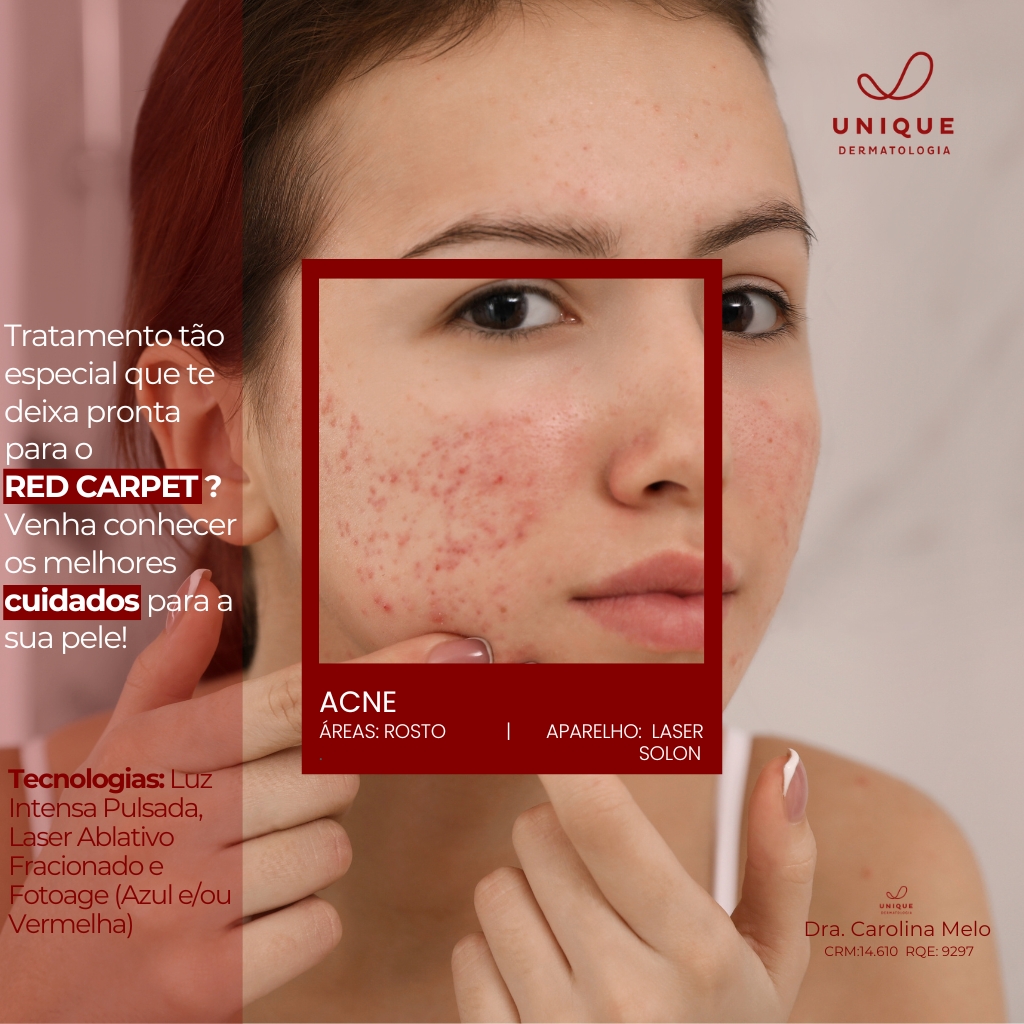 1. Rotina de Skincare para Pele Acneica: Passo a Passo
2. Isotretinoína: Tudo o que Você Precisa Saber Antes de Usar
3. Antibióticos para Acne: Quando São Indicados?
4. Tratamentos Naturais vs. Medicamentosos para Acne
5. Como Lidar com Cicatrizes de Acne: Opções de Tratamento