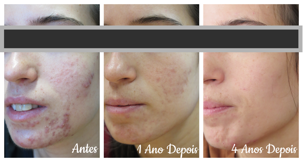 acne tratamento