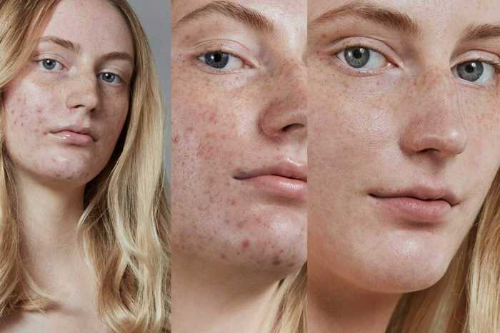 1. Rotina de Skincare para Pele Acneica: Passo a Passo
2. Isotretinoína: Tudo o que Você Precisa Saber Antes de Usar
3. Antibióticos para Acne: Quando São Indicados?
4. Tratamentos Naturais vs. Medicamentosos para Acne
5. Como Lidar com Cicatrizes de Acne: Opções de Tratamento