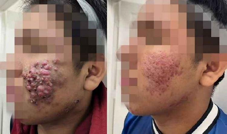 1. Rotina de Skincare para Pele Acneica: Passo a Passo
2. Isotretinoína: Tudo o que Você Precisa Saber Antes de Usar
3. Antibióticos para Acne: Quando São Indicados?
4. Tratamentos Naturais vs. Medicamentosos para Acne
5. Como Lidar com Cicatrizes de Acne: Opções de Tratamento