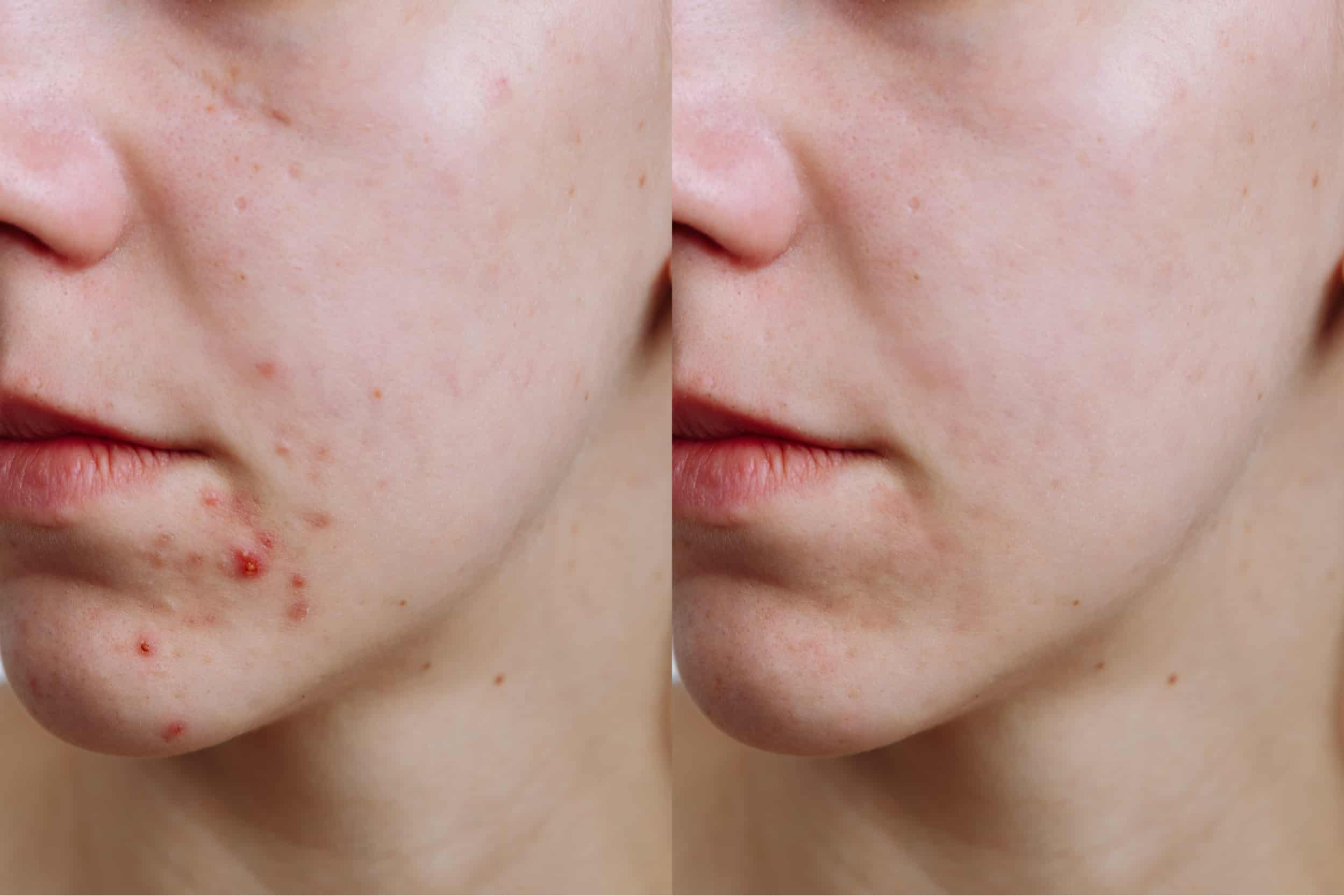 1. Rotina de Skincare para Pele Acneica: Passo a Passo
2. Isotretinoína: Tudo o que Você Precisa Saber Antes de Usar
3. Antibióticos para Acne: Quando São Indicados?
4. Tratamentos Naturais vs. Medicamentosos para Acne
5. Como Lidar com Cicatrizes de Acne: Opções de Tratamento