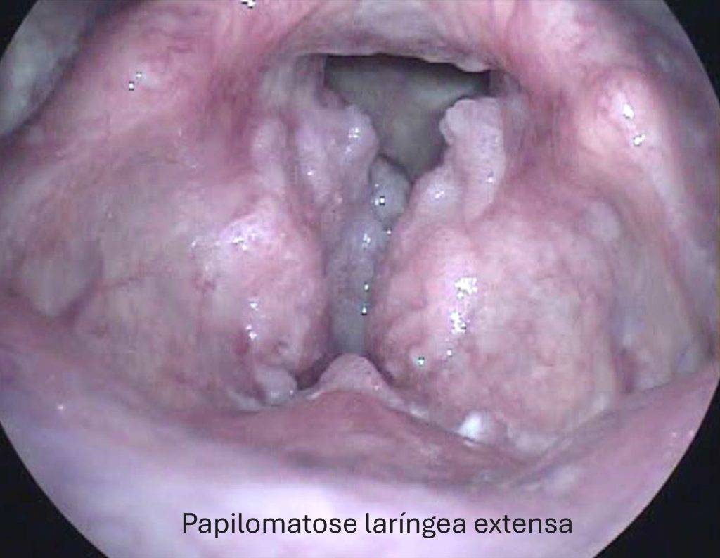 Receitas de Purês Nutritivos para Facilitação da Deglutição