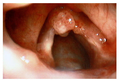 Como Fortalecer a Imunidade Naturalmente Contra o HPV