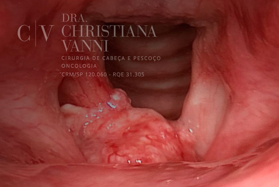 Vitaminas Essenciais para Combater o HPV e Proteger a Laringe