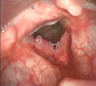 Álcool e HPV na Laringe