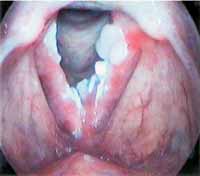 Como Fortalecer a Imunidade Naturalmente Contra o HPV