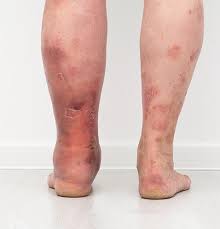 Mitos e Verdades sobre Álcool e Saúde Vascular