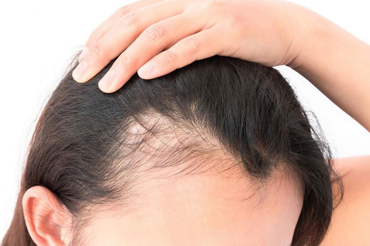Minoxidil para Alopecia Feminina: Guia Completo de Uso e Efeitos