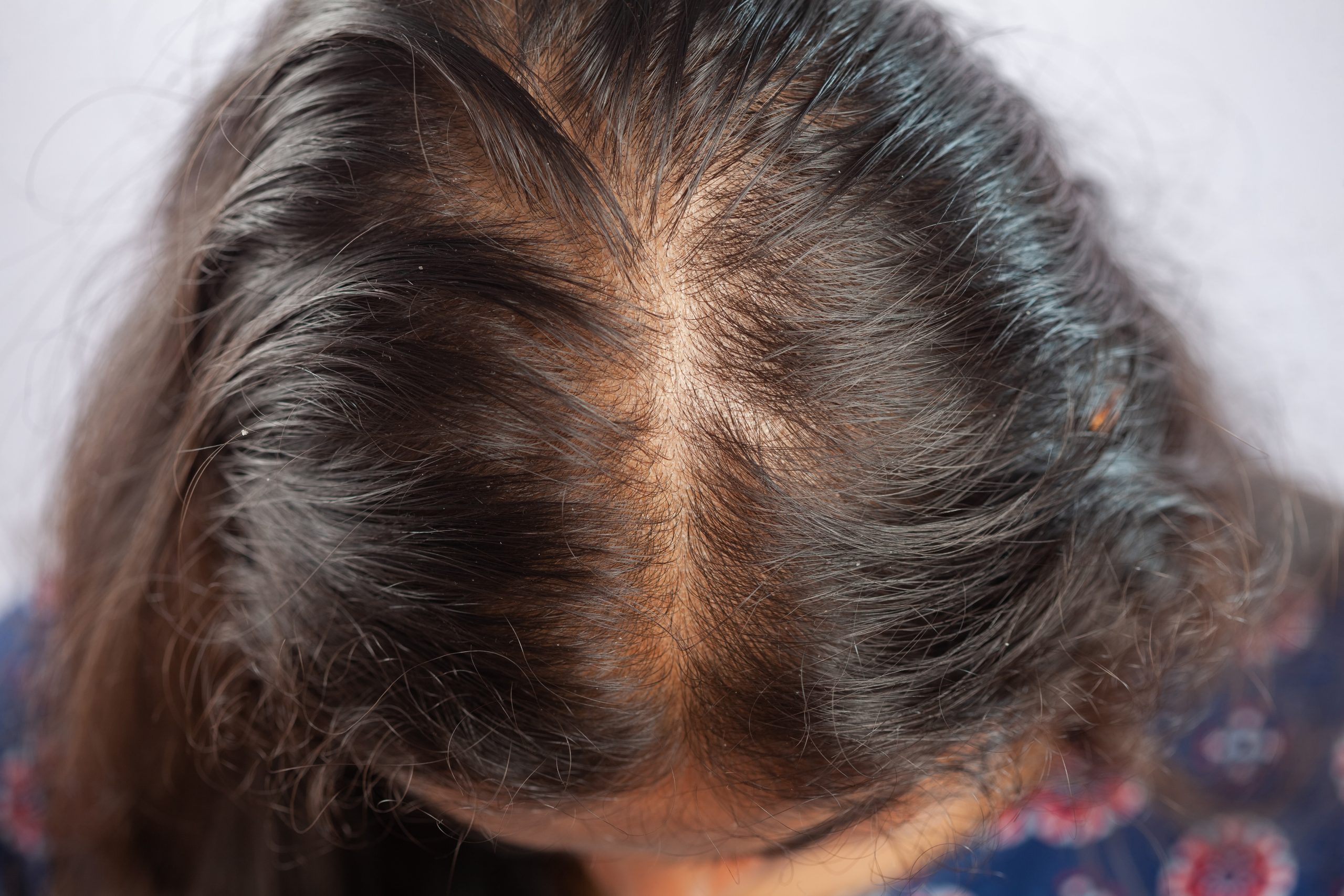SOP e Queda de Cabelo: Entenda a Relação com a Alopecia Androgenética