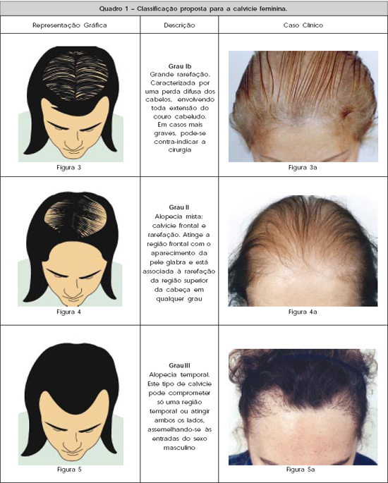 Diagnóstico da Alopecia Androgenética Feminina: Escalas de Ludwig e Sinclair Explicadas