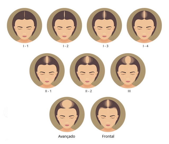 alopecia androgenética feminina