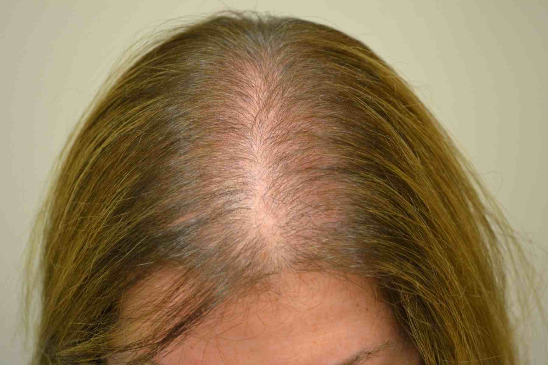 Minoxidil para Alopecia Feminina: Guia Completo de Uso e Efeitos