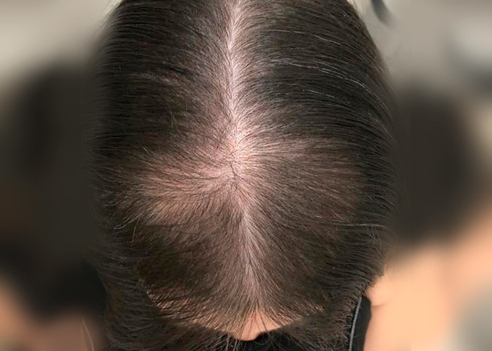SOP e Queda de Cabelo: Entenda a Relação com a Alopecia Androgenética