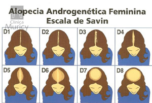 Implante Capilar Feminino: Quando Considerar e Quais as Técnicas Mais Modernas