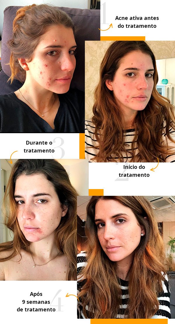 anticoncepcional para acne