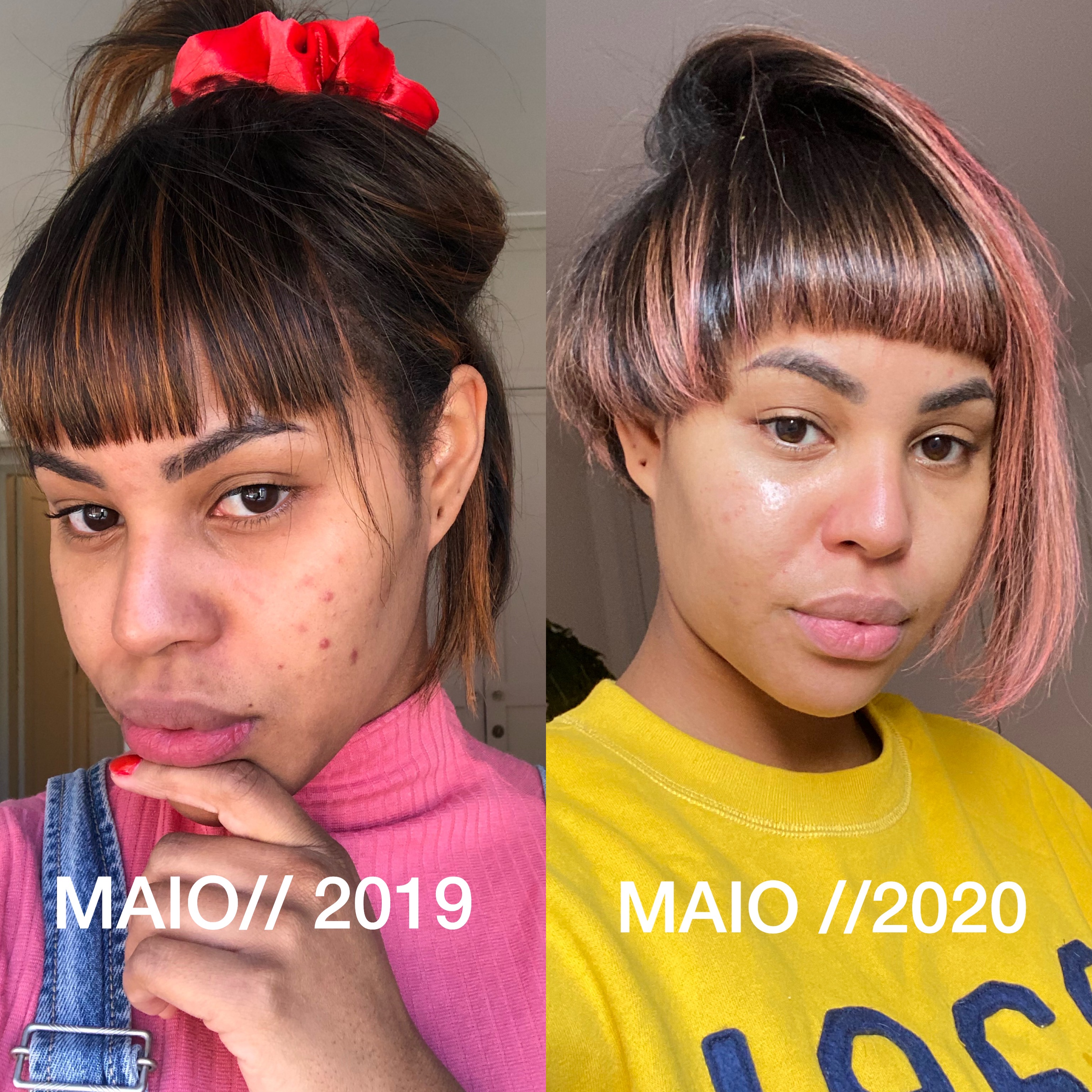 Mitos e Verdades: Anticoncepcionais que Pioram a Acne (DIU Mirena, Implanon)