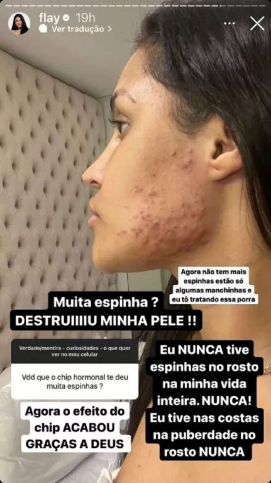 anticoncepcional para acne
