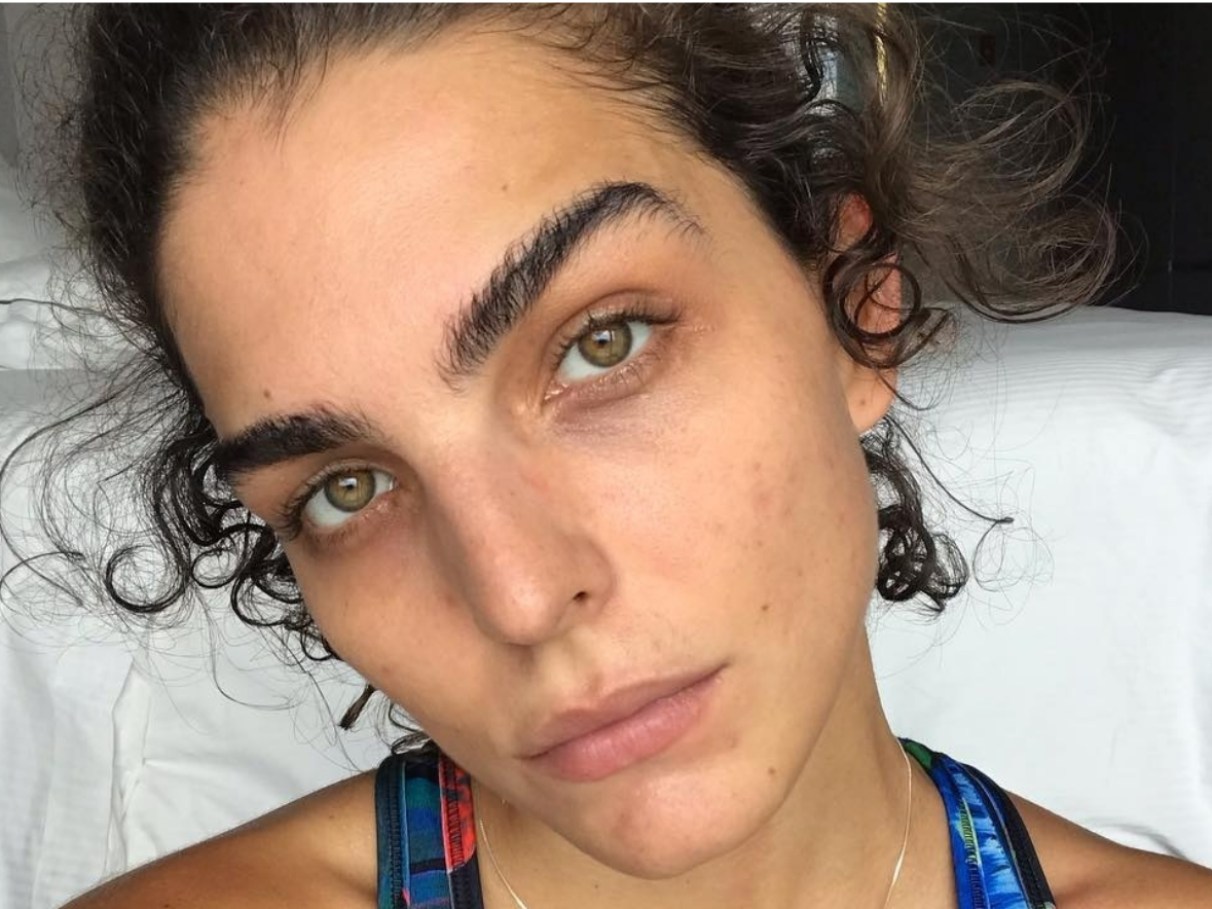 Mitos e Verdades: Anticoncepcionais que Pioram a Acne (DIU Mirena, Implanon)