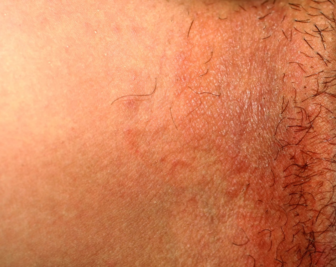 Prevenção de Assaduras em Atletas: Dicas Essenciais