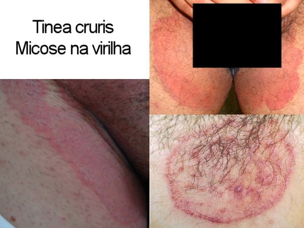 Cuidados com a Higiene Íntima para Evitar Assaduras e Micoses