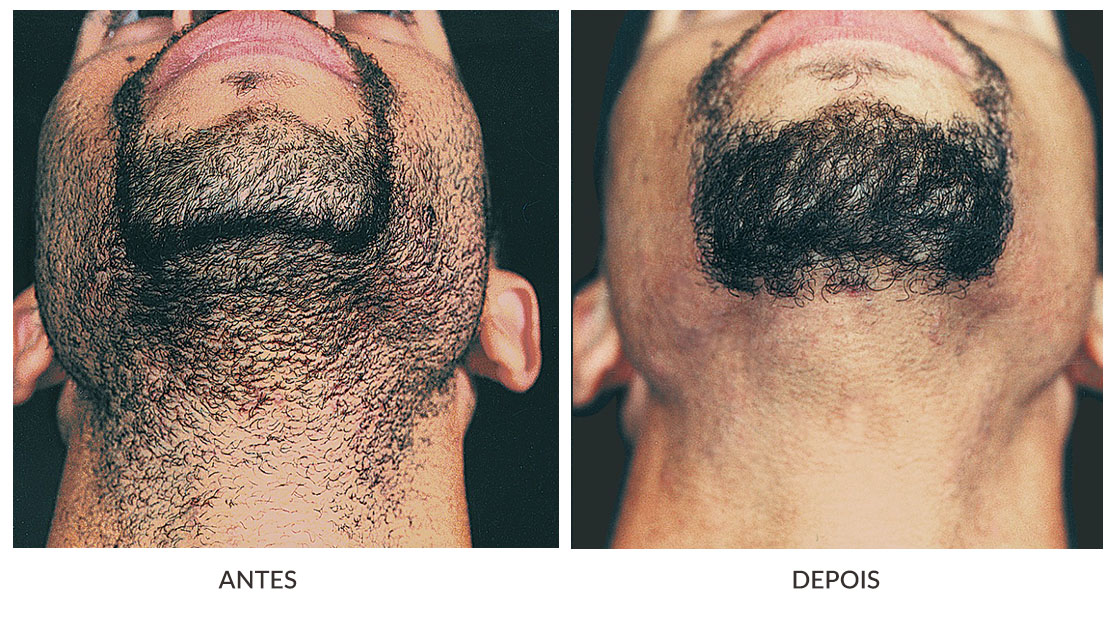 Adeus Foliculite: Como o Laser Transforma a Pele da Barba