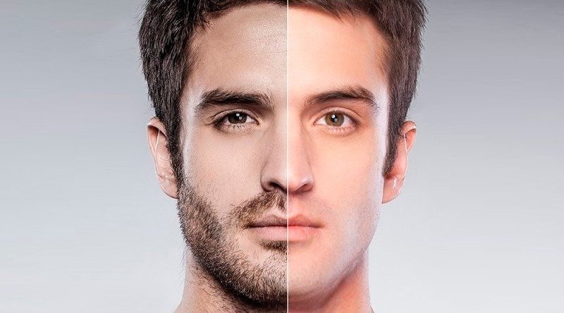 Investimento em Beleza: Quanto Custa a Depilação a Laser da Barba?