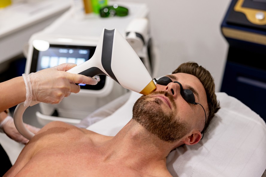 Depilação a Laser para Barba: Mitos e Verdades Revelados