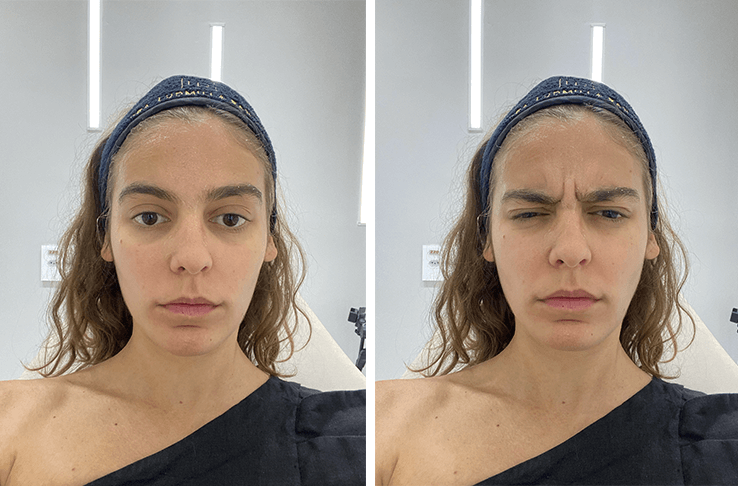 Botox Preventivo: Mitos e Verdades sobre o Tratamento