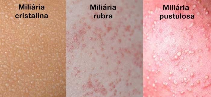 brotoeja em bebê fotos