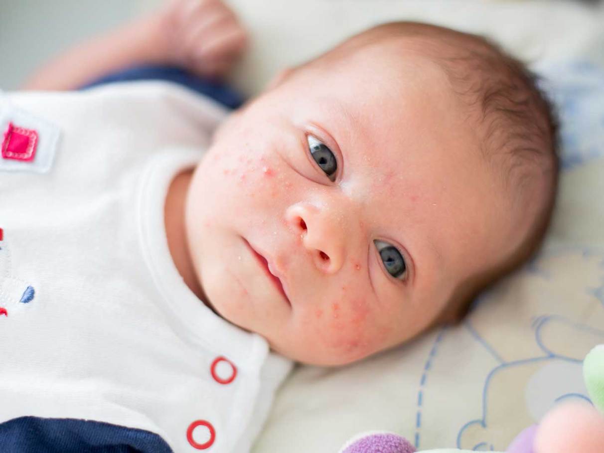 5 ideias de títulos:
1. Brotoeja em Bebês: Guia Completo para Identificação e Cuidados
2. Alívio Rápido: Como Tratar Brotoejas em Recém-Nascidos
3. Prevenindo Brotoejas: Dicas Essenciais para o Verão do seu Bebê
4. Brotoeja ou outra condição? Saiba diferenciar e agir
5. Remédios Caseiros e Médicos para Brotoejas em Bebês: O que Funciona?