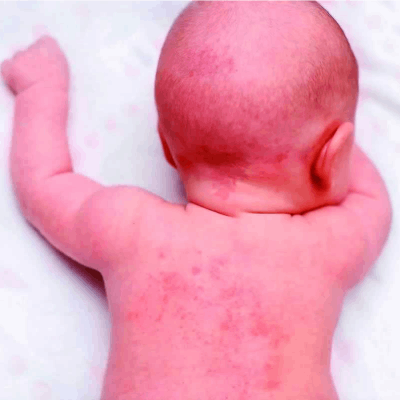 brotoeja em bebê fotos