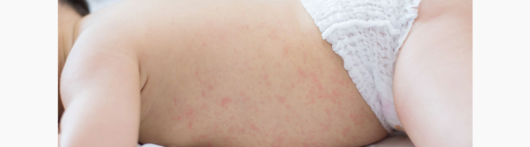 5 ideias de títulos:
1. Brotoeja em Bebês: Guia Completo para Identificação e Cuidados
2. Alívio Rápido: Como Tratar Brotoejas em Recém-Nascidos
3. Prevenindo Brotoejas: Dicas Essenciais para o Verão do seu Bebê
4. Brotoeja ou outra condição? Saiba diferenciar e agir
5. Remédios Caseiros e Médicos para Brotoejas em Bebês: O que Funciona?