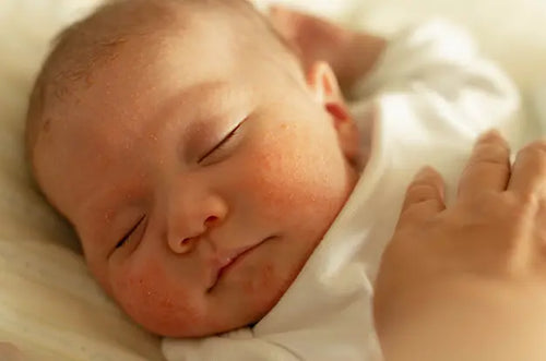 brotoeja em bebê fotos